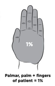 CPG burns palmar palm fingers CPG burns palmar palm fingers